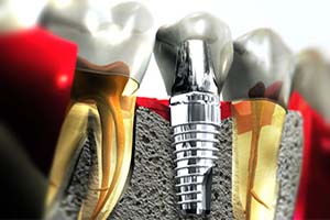 dental implants in dominican republic