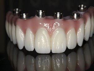 Full Arch Implant Bridge Santo Domingo