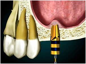 Sinus Lift Dominican Republic